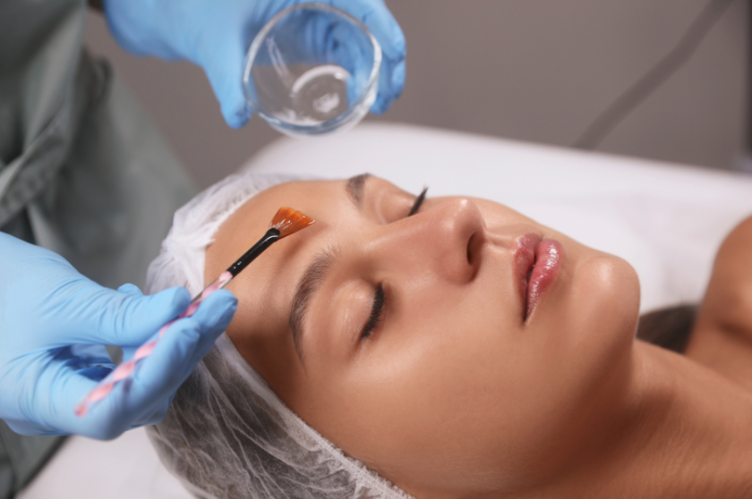 Chemical Peel